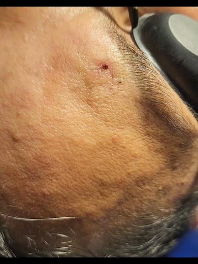 Laser Removal for Pyogenic Granuloma