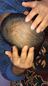 dermaroller for hair growth | dermaroller for hair loss | how to use derma roller for hair growth