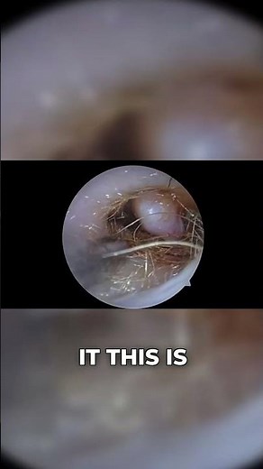 Colossal Ear Polyp Tangled In Earwax Removal | Expert Audiologist | Wax Off Episode 69 Shorts