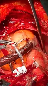Resection Myxoma and MVR (Dr Zeraatian)