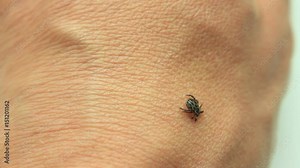 Dog Tick, Dermacentor variabilis, Encephalitis, Ixodes scapularis on human skin