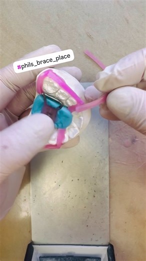 Dental Braces: What You Need to Know