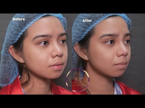 How to do repeat nose thread lift ?