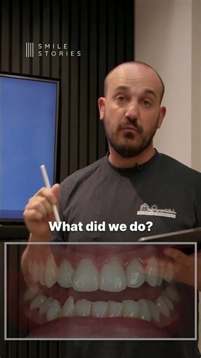 Georgia's Natural Smile Makeover #dentist #cosmeticdentist #invisalign