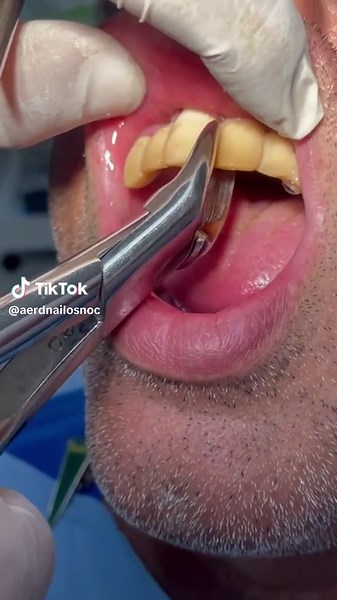 Dental Procedure: Plaque Removal Techniques Explained