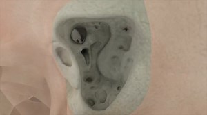 Mastoid Surgery Animation (Basic to Radical Mastoidectomy)