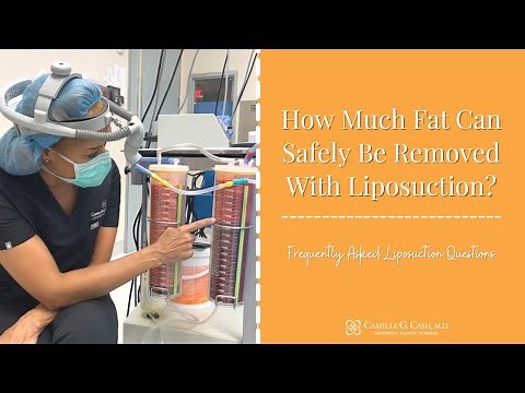How Much Fat Can Safely Be Removed Via Liposuction?