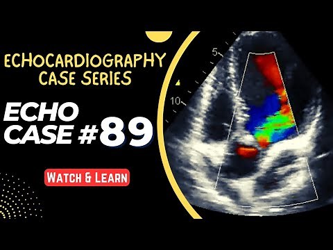 ECHO CASE 89 | Echocardiography Case Series | Echocardiogram Interpretation | 2D Echo Basics
