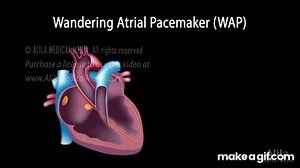 Wandering Atrial Pacemaker (WAP) & Multifocal Atrial Tachycardia (MAT) on Make a GIF