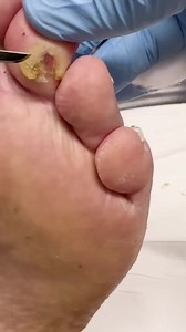 Ulcerating corn removed by podiatristl🦶. . . #footpain #plantarfasciitis #heelpain #podiatry #footcare #podiatrist #orthotics #feet #foothealth #kneepain #foot #running #anklepain #backpain #bunions #flatfeet #healthyfeet #footpainrelief #arthritis #health #footdoctor #bunion #fyp #foryou #viralreels #exploretheworld | Docpods Treatment