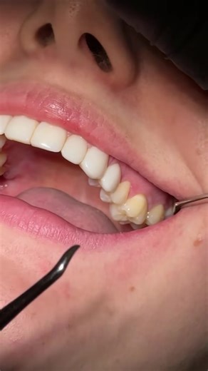 Quick Wisdom Tooth Extraction in Under 30 Seconds