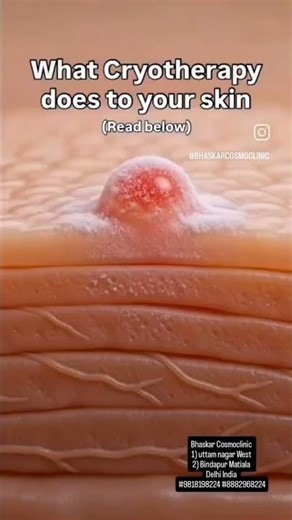 #Wart #removal