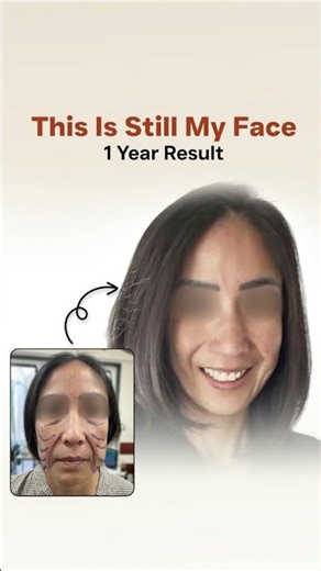 Infinite Thread Facelift Before After #nonsurgicallift