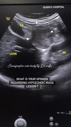 150K views · 975 reactions | RADIOLOGY ULTRASOUND SONOGRAPHY #fblifestyle #education #reelsvideo #sonographiccasestudy | Sonographic case study | Facebook