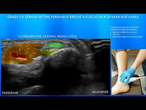 Ultrasound of a Peroneus Brevis Strain in a 21 Year Old Male by probeultrasound.com
