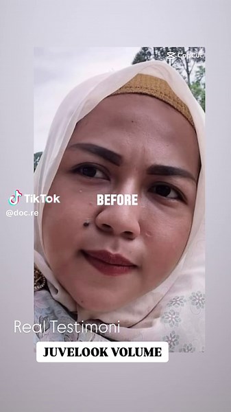 Juvelook Volume: Hasil Menakjubkan Dalam Skincare