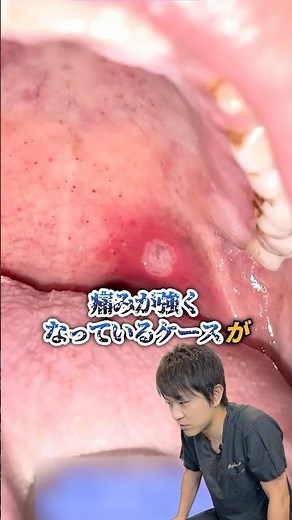 歯科医師が解説！！口内炎ができる原因とは】#歯医者 #shorts #白金高輪リューズ歯科
