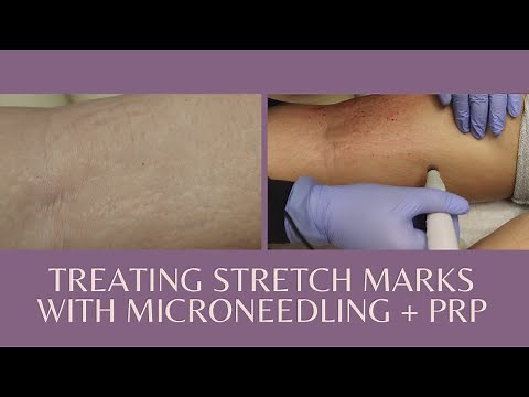 Treating stretch marks with Microneedling + PRP