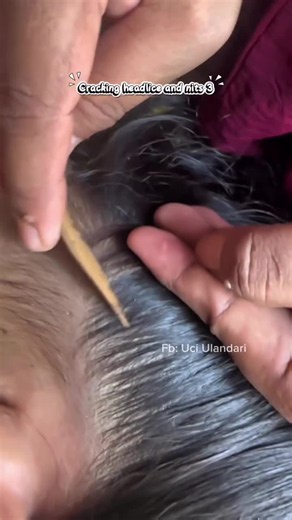 How to Remove Lice at Home: Best Methods for Lice Removal