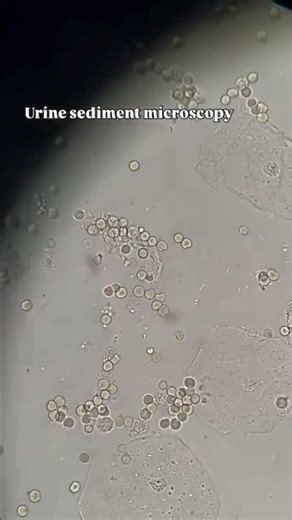 urine Sediment microscopy #urine