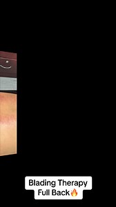 Blading Therapy Full Back🔥 Blading Therapy (IASTM) Benefits:✅Improved Blood Flow✅Reduced Muscle Tightness ✅Enhanced Range of Motion✅Pain Reduction✅Faster Recovery✅Prevention of Injuries✅Improved Athletic Performance✅Targeted Treatment✅Scar Tissue Reduction✅Complementary Therapy#fy #fyp #foryou #tiktoktrending #fbreelsvideo #fbreels #qualityservice #followformore #SharePost #thankyouforyoursupport | Jerald M David