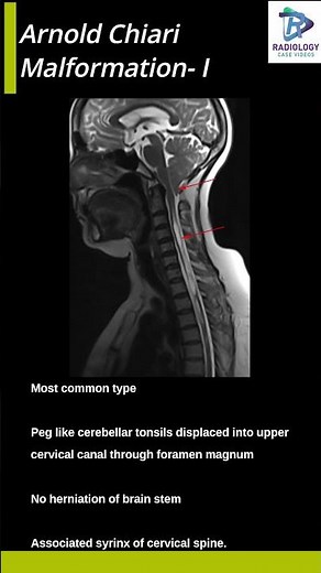 Arnold Chiari Malformation- I