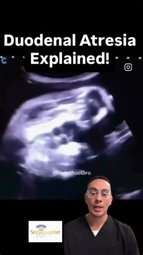 Sonographer Pal on Instagram: "LINK IN BIO! The “Double Bubble”: A Textbook Case 🫧👶 Huge shout-out to @radschoolbro for sharing this clear example of Duodenal Atresia at 31 weeks! What are the signs? The “Double Bubble” is the gold standard finding. It represents a dilated stomach and a dilated proximal duodenum. Because of the obstruction, amniotic fluid can’t pass through, which often leads to Polyhydramnios (excessive amniotic fluid). The Registry Connection: If you see this on your boards,