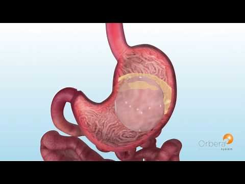 ORBERA Balloon - How It's Inserted and Removed