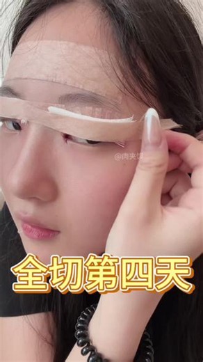 第四天的恢复情况来啦～#双眼皮恢复 #双眼皮手术术后经验分享 #全切双眼皮 #双眼皮日常 #双眼皮恢复记录