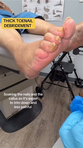 If you are a diabetic patient and have thick toenails, it is important that you get it taken care of as often as possible. This patient has fake toenails, and it had caused her a wound that was then producing pus. If left untreated, this can become a serious infection that could be a risk to her toes and her life. The infection could overtake her toes, which may need amputation and then she may have blood infection, which may need hospitalization. So having thick toenails is something that needs