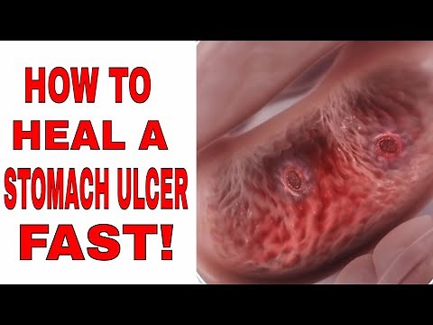 How to Heal a Stomach Ulcer Fast (How to Fix a Stomach Ulcer)