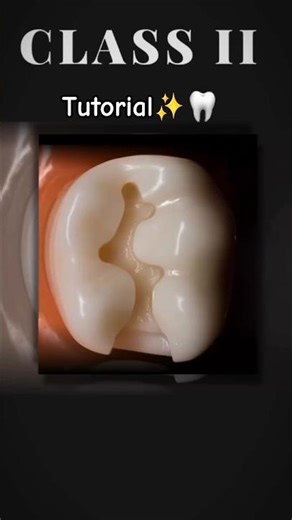 Class II tutorial✨🦷❤#class2 #حشوات_الأسنان #اكسبلور #تجميلاسنان