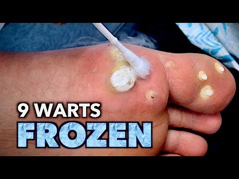 9 WARTS FROZEN on 1 FOOT (with liquid nitrogen) | Dr. Paul