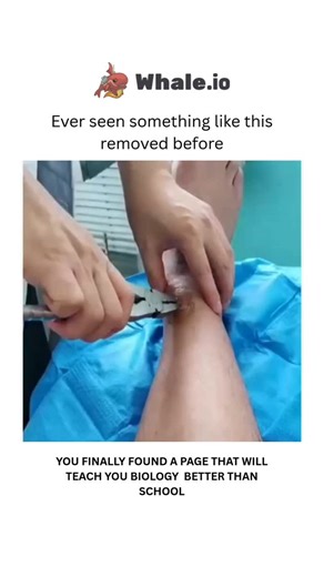 Medical on Instagram: "Definition of K-Wire Stabilization K-Wire (Kirschner wire) stabilization is a surgical technique used to fix and stabilize bone fractures. Thin metal wires called K-wires are inserted through the skin into the bone to hold bone fragments in the correct position during healing. This is a temporary form of fixation that is usually used for small bones (such as those in the hand, wrist, or foot). K-wire removal is the process of removing the K-wires after the bone has healed 