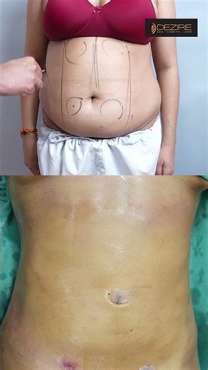 360 Abdomen Liposuction