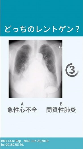 【10秒で解説】心不全でのレントゲン特徴
