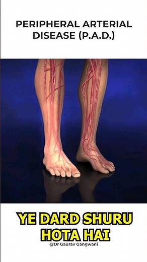 Claudication In Legs Symptoms | Claudication | Leg Pain | Dr. Gaurav Gangwani