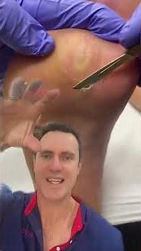 / docpods #callus corn and callus removal explained by australian podiatrist #corn #callus #podiatri