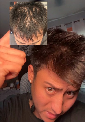 Transform Your Hair: The DHT Blocker Journey