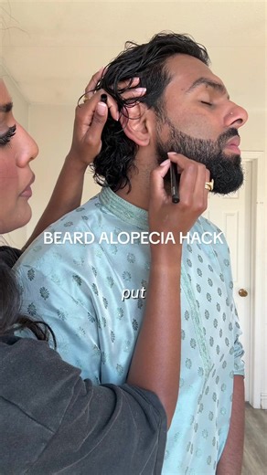 Beard Alopecia Hack: Temporary Fix for Patchy Facial Hair