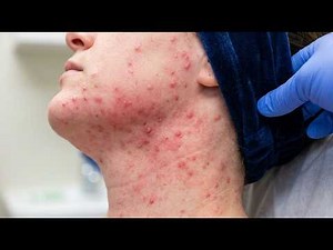 Loan Nguyen Acne Treatment 15ll
