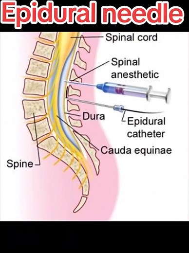Epidural Needle Insertion Demonstration for Students