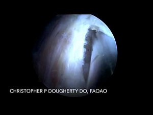 Arthroscopic partial thickness hamstring tear repair