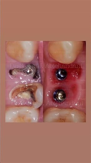 Socket shield technique | Implant Dentistry | #dentalimplants #implantdentistry #dentaleducation