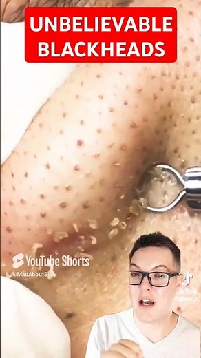 Truly Unbelievable BLACKHEAD REMOVAL - So Many Blackheads #shorts