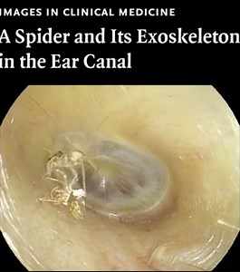 Doctors find spider in woman’s ear after hearing ‘abnormal sounds’