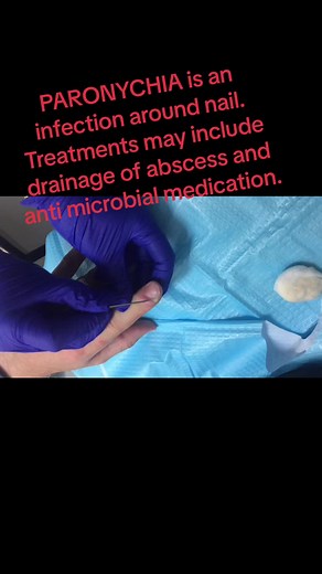Nerve Block and Drainage for Paronychia Infection | Finger Abscess Treatment