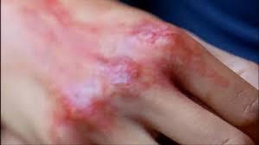 Die richtige erste Hilfe bei Brandverletzungen