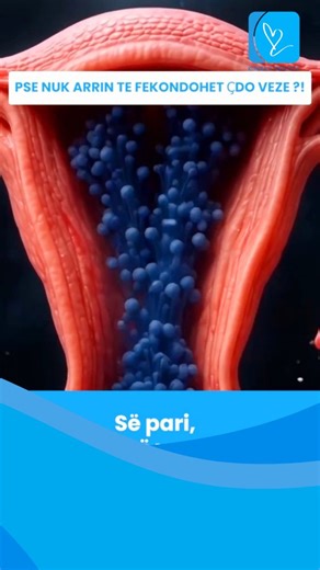klinikafertilitetithygeia on Instagram: "🧫 Ja pse jo çdo Vezë arrin të fekondohet ... ….Kjo për faktin e thjeshtë që vetëm Ovulimi nuk mjafton. Që të ndodhë Fekondimi, ndikojnë shumë faktorë dhe përkatësisht: ✔️ cilësia e Vezës ✔️ cilësia /shëndeti i Spermës ✔️ balanca e hormoneve ✔️ koha e duhur ✔️ stresi ✔️ prezenca e inflamacionit në organizëm ❗ Nëse njëri prej këtyre faktorëve nuk është në rregull atëherë fekondimi mund të mos ndodhë. 🏥 Prandaj në #Klinika e Fertiltetit Hygeia stafi ynë pu