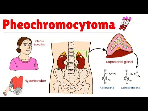 Understanding Pheochromocytoma: Symptoms, Diagnosis, Treatment